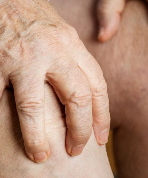 U Hrvatskoj prvi primer nakon 30 godina. Što je guba i kako nastaje?